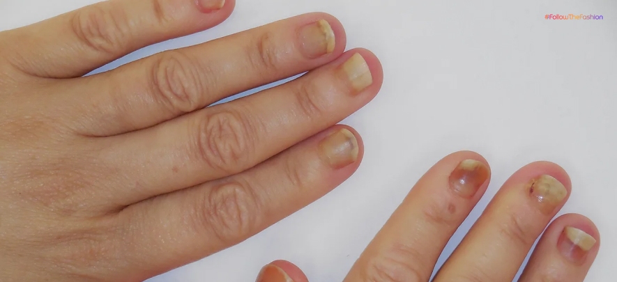 How To Repair Damaged Nails?